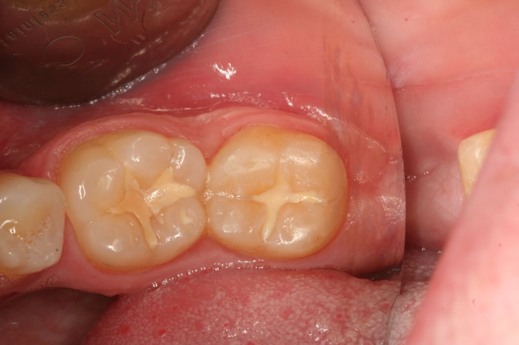Zahnfüllungen und Inlays